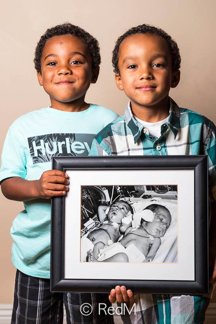 Noah e Nathan, nati a 32 settimane 